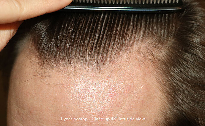 Case performed by Dr. Feriduni – 3322 FU in 1 procedure photo