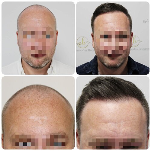 Dr Bonaros, Glasgow, UK / 4076 FUE grafts / 0-12 Months photo