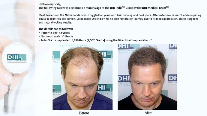 DHI India™ | NW 6 | 2,507 Grafts | 4 Months Hair Transplant Results photo