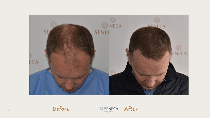 Seneca Medical Group - 3189 grafts with Direct Fue photo