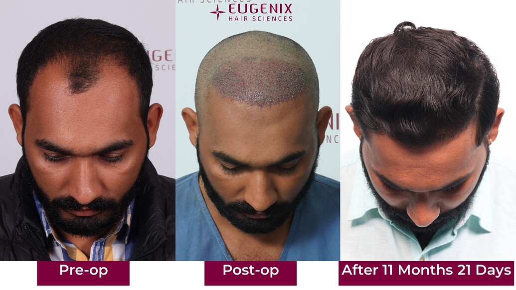 https://cdn.forumhairtransplant.com/optimized/3X/4/5/4597f077b5b7a281769396aa95deaa65061372a2_2_1035x582.jpeg