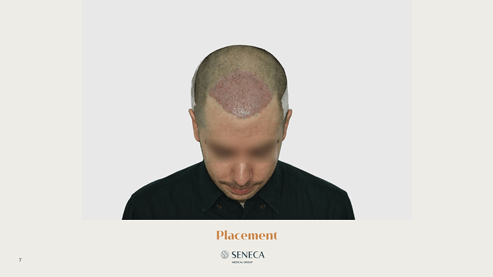Seneca Medical Group - 746 grafts with Direct FUE photo