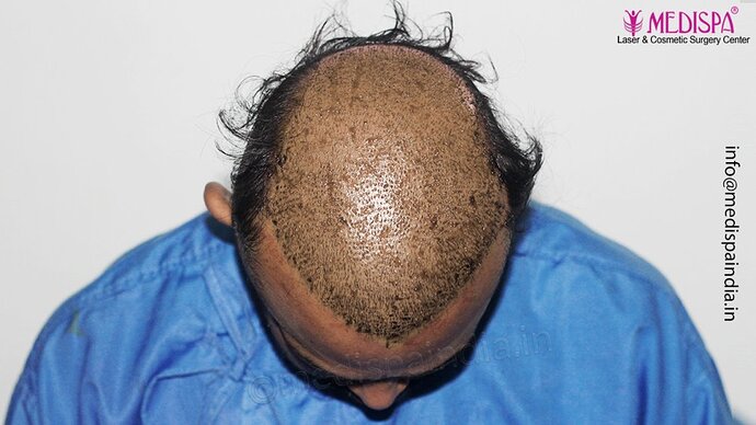 Dr. Suneet Soni - 5498 Grafts, 2 Years Result, Combine FUT + FUE + Beard Technique, NW-VI photo