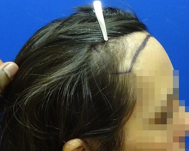 Dr. Bisanga, BHR Clinic, 2000 FUE / 0-8 Months - Female Case photo