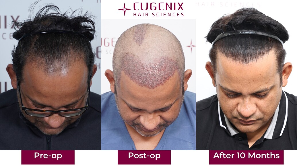 https://cdn.forumhairtransplant.com/optimized/3X/4/5/45df009264050bb6de319b2c17edf16035f20645_2_1035x582.jpeg