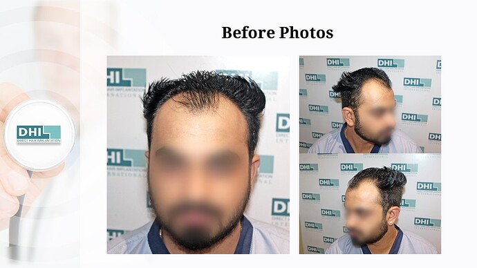 DHI India | Hair Line Reconstruction | Grade 3 | 2,088 Grafts | 10 Months Hair Transplant Results photo