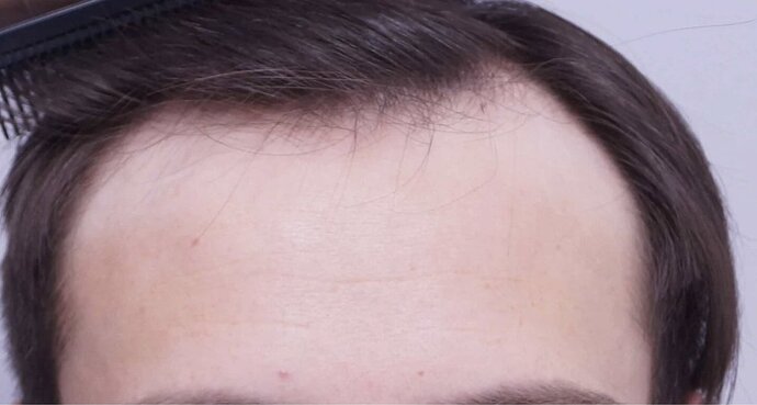 Dr Bessam Farjo FUE 1720 grafts to frontal recessions photo