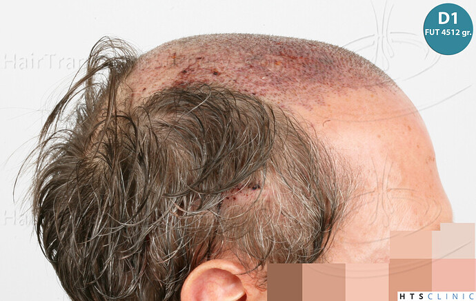 Dr Devroye + Dr Montesanti + Dr Jenard / 7015 grafts (4512 FUT + 2503 FUE) / 2 sessions photo