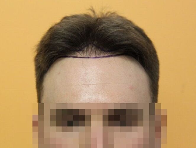 Dr.Bisanga, BHR Clinic, 1675 FUE, 0 - 13 Months photo