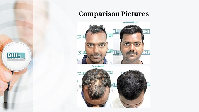 DHI India | NW 4 | 2,354 Grafts | 7-Months DHI Hair Transplant Results photo