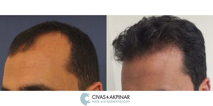 Civas&Akpınar Hair Transplant- FUE Hair Transplant Before & After Pictures (3100 Grafts) photo