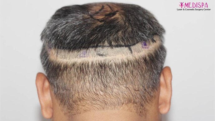 11600 Grafts in 3 FUT Sittings by Dr Suneet Soni photo