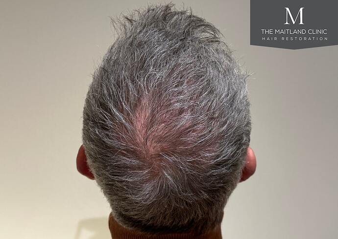 Dr Ball - The Maitland Clinic 2448 Grafts By FUT photo