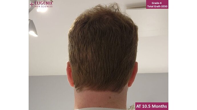 EUGENIX HAIR SCIENCES | ALEXANDRE | 10.5 MONTHS RESULT photo