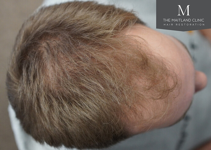 1826 grafts by FUE with Dr Edward Maitland Ball at The Maitland Clinic photo