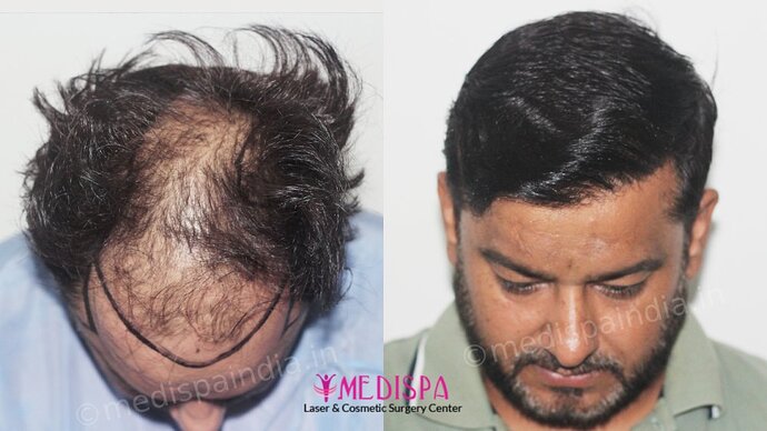 Dr. Suneet Soni - 5000 Grafts, Combine FUT + FUE + BHT (Beard) Technique, NW-V, 2.5 Year Result photo