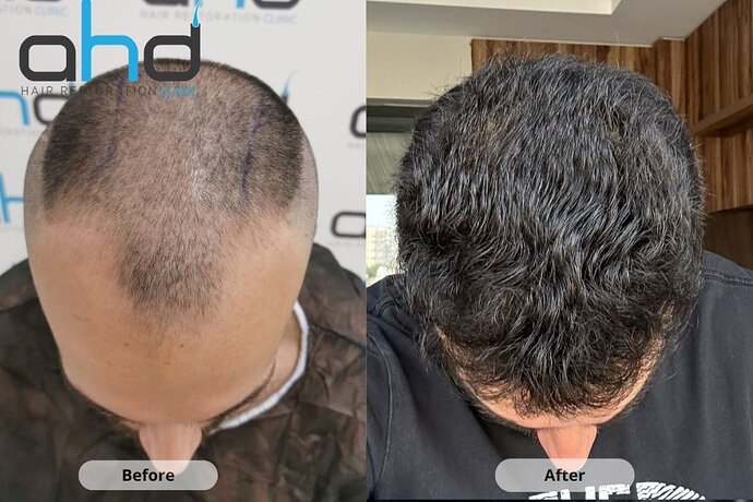 AHD Clinic / Technicians / 4050 grafts / FUE + DHI photo