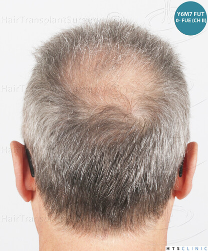 Dr Devroye + Dr Montesanti + Dr Jenard / 7015 grafts (4512 FUT + 2503 FUE) / 2 sessions photo