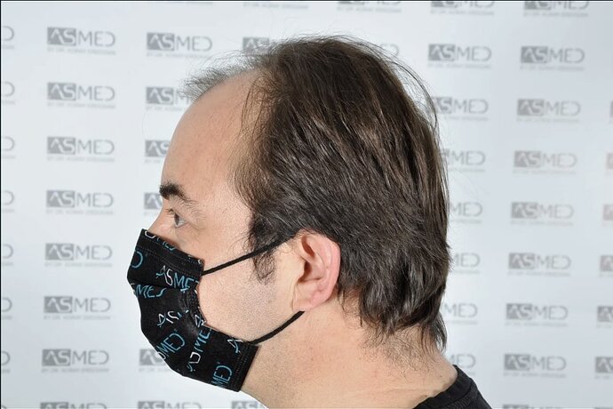 ASMED CLINIC - DR.KORAY - 5060 GRAFTS FUE photo