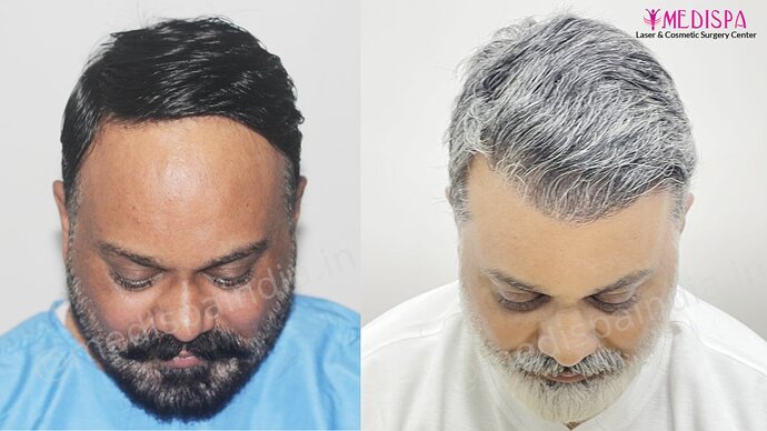 Dr. Suneet Soni - 4190 Grafts, Combine FUT + FUE + Beard Technique, NW- III photo