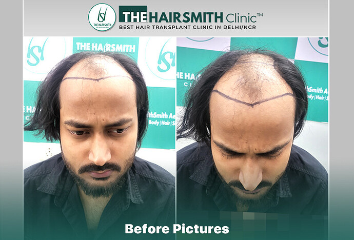 The HairSmith Clinic Delhi | NW Stage 6 | 3785 Grafts | 11 Months Hair Transplant Result photo