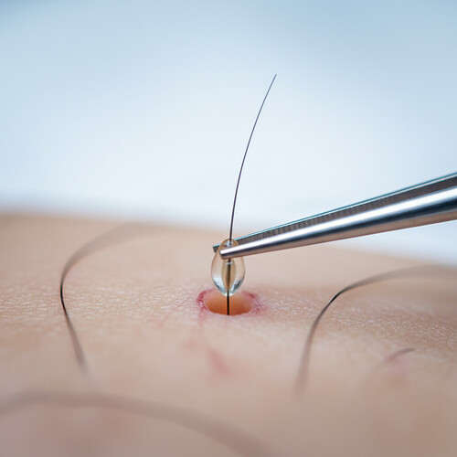 Microscopic view of hair follicle transplantation