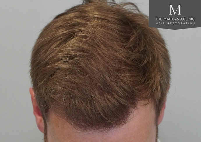 1826 grafts by FUE with Dr Edward Maitland Ball at The Maitland Clinic photo