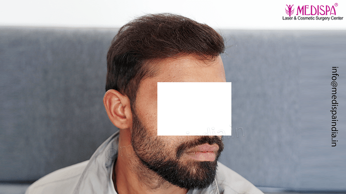 Dr. Suneet Soni - 5360 Grafts | 12-Month Result | Combination FUT + FUE + Beard photo