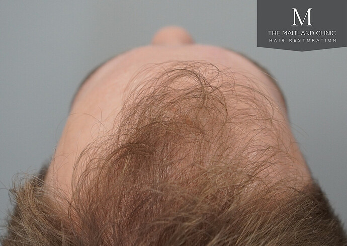 1826 grafts by FUE with Dr Edward Maitland Ball at The Maitland Clinic photo