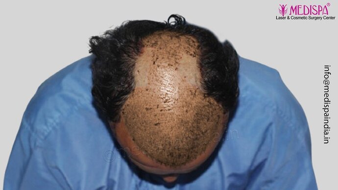 Dr. Suneet Soni - 5000 Grafts, Combine FUT + FUE + Beard Technique, NW-V photo
