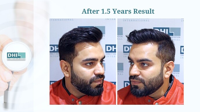 DHI India™ | NW 3 | 1,524 Grafts | Youthful Hairline Restored | DHI Hair Transplant photo