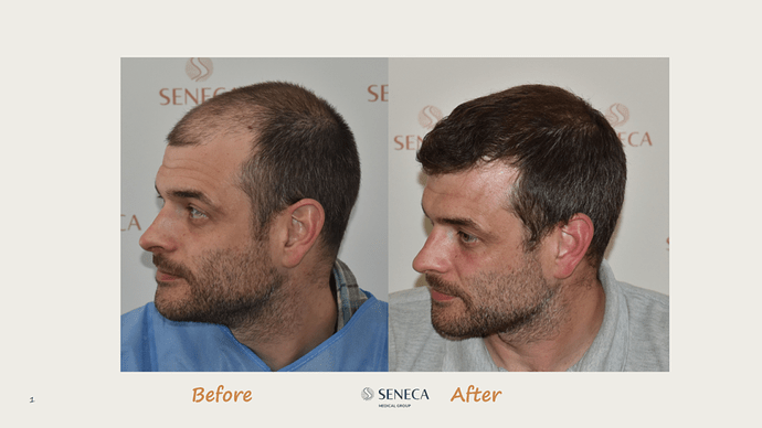 Seneca Medical Group - 2308 grafts with Direct Fue photo