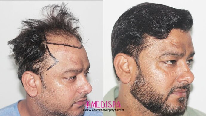 Dr. Suneet Soni - 5000 Grafts, Combine FUT + FUE + BHT (Beard) Technique, NW-V, 2.5 Year Result photo