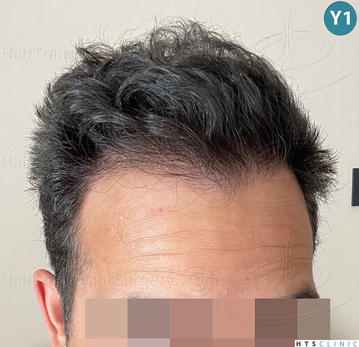 Dr Devroye + Dr Montesanti + Dr Jenard, HTS Clinic / 2018 FUE / Hairline & frontal area photo