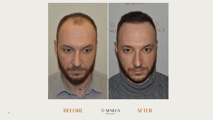 Seneca Medical Group - 1517 grafts with Direct FUE photo