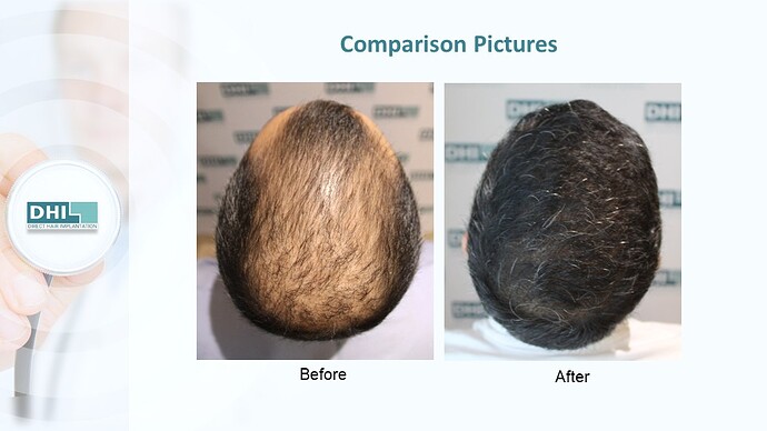 DHI India™ | NW 5 | 2,985 Grafts | 12 Months DHI Hair Transplant Results photo