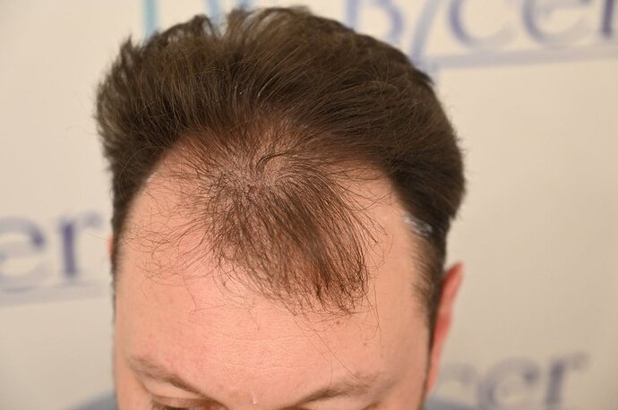 Ozlem Bicer MD-Hair Transplant-2910 Grafts FUE by micro-motor, 7. months result photo
