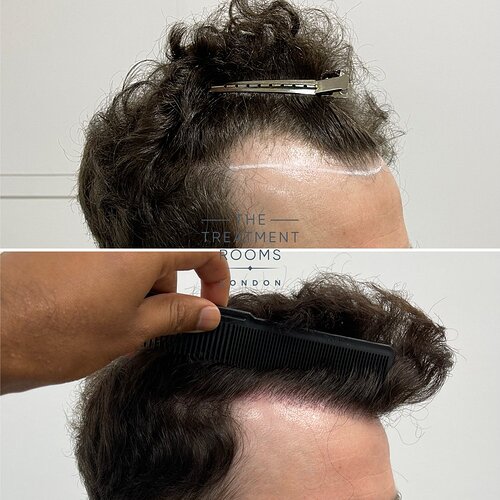 FUE Hairline Restoration 1306 Grafts- The Treatment Rooms London photo