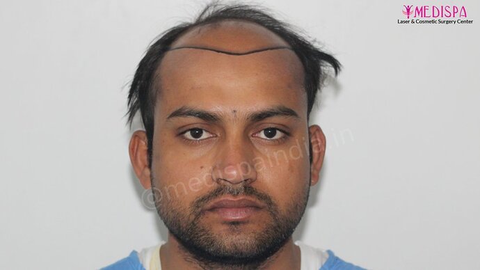 Dr. Suneet Soni - 5587 Grafts, Combine FUT + FUE + Beard Technique, NW : V-VI photo
