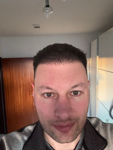 Ozlem Bicer MD-Hair Transplant-2910 Grafts FUE by micro-motor, 7. months result photo