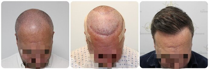 Dr Bonaros, Glasgow, UK / 4076 FUE grafts / 0-12 Months photo