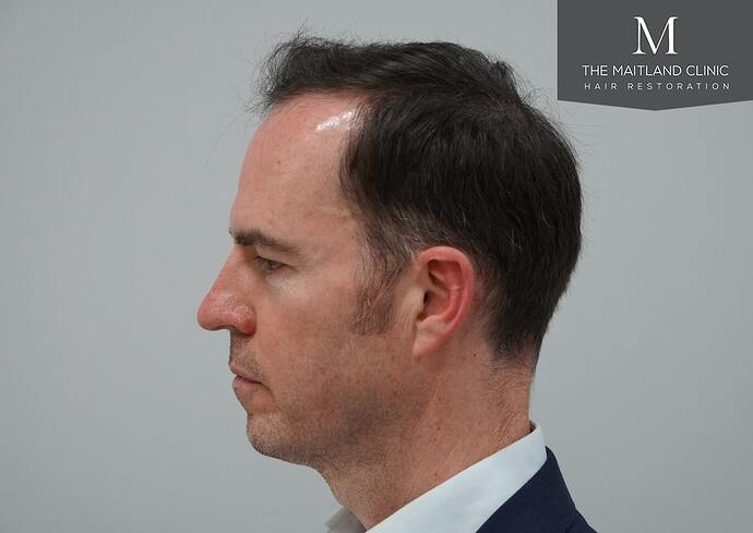 Dr Ball - The Maitland Clinic 1432 Grafts By FUE photo