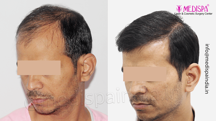 Dr. Suneet Soni - 4533 Grafts, Combine FUT + FUE Technique , NW-IV/V photo