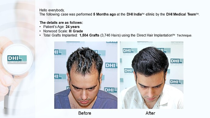 DHI India™ | NW 3 | 1,504 Grafts | 5 Months DHI Hair Transplant Results photo