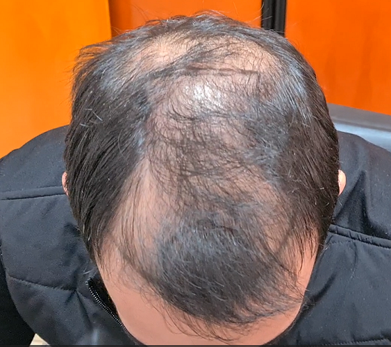 Result of 4000 grafts – 11 months after – NW class 4 photo