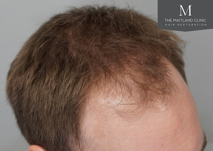 1826 grafts by FUE with Dr Edward Maitland Ball at The Maitland Clinic photo