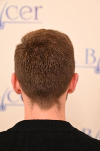 Ozlem Bicer MD-2340 Grafts FUE by micro-motor, 12. month result  photo