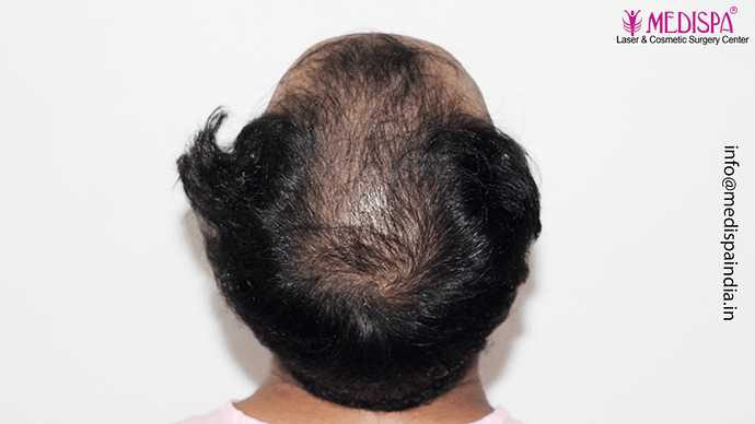 Dr. Suneet Soni - 4046 Grafts | 12-Month Result | Combination FUT + FUE + Beard photo