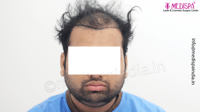 Dr. Suneet Soni - 5467 Grafts, Combine FUT + FUE + Beard Technique, NW- V, 3 Years Result photo