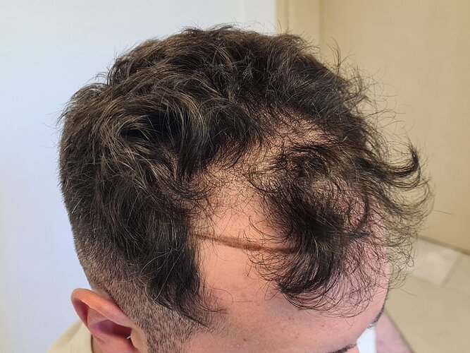 Result of NW3 patient after 3230 grafts after 7 months – HDC Hair Clinic – Dr Christina photo